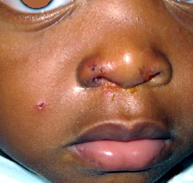 Impetigen