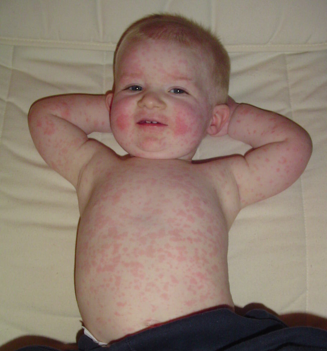 Infectious Erythema