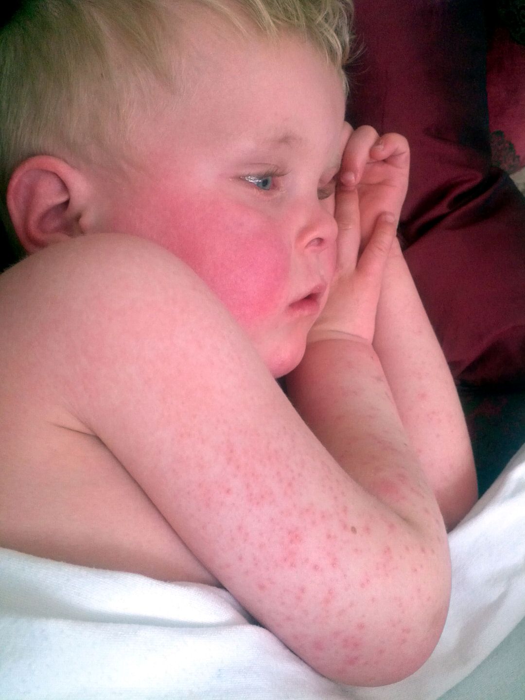 Scarlet fever exanthema
