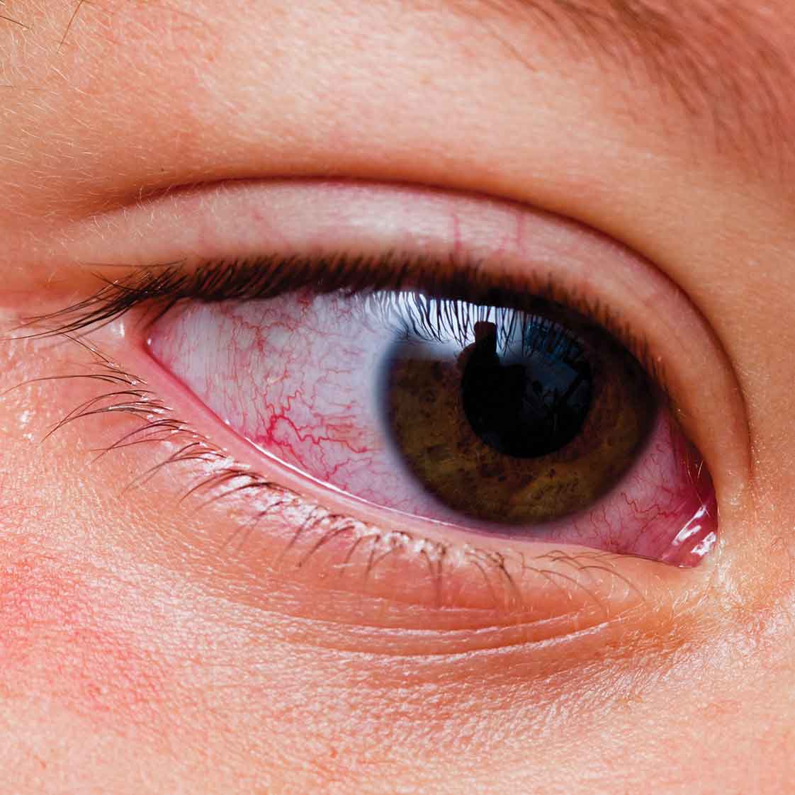 Kawasaki conjunctivitis