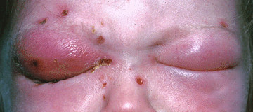 Cellulite périorbitaire