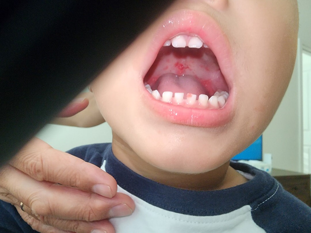 Mains, pieds et bouche enfant
