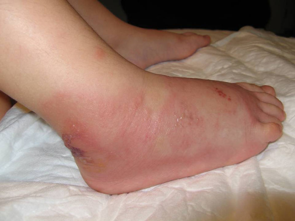 Celulitis extremidad