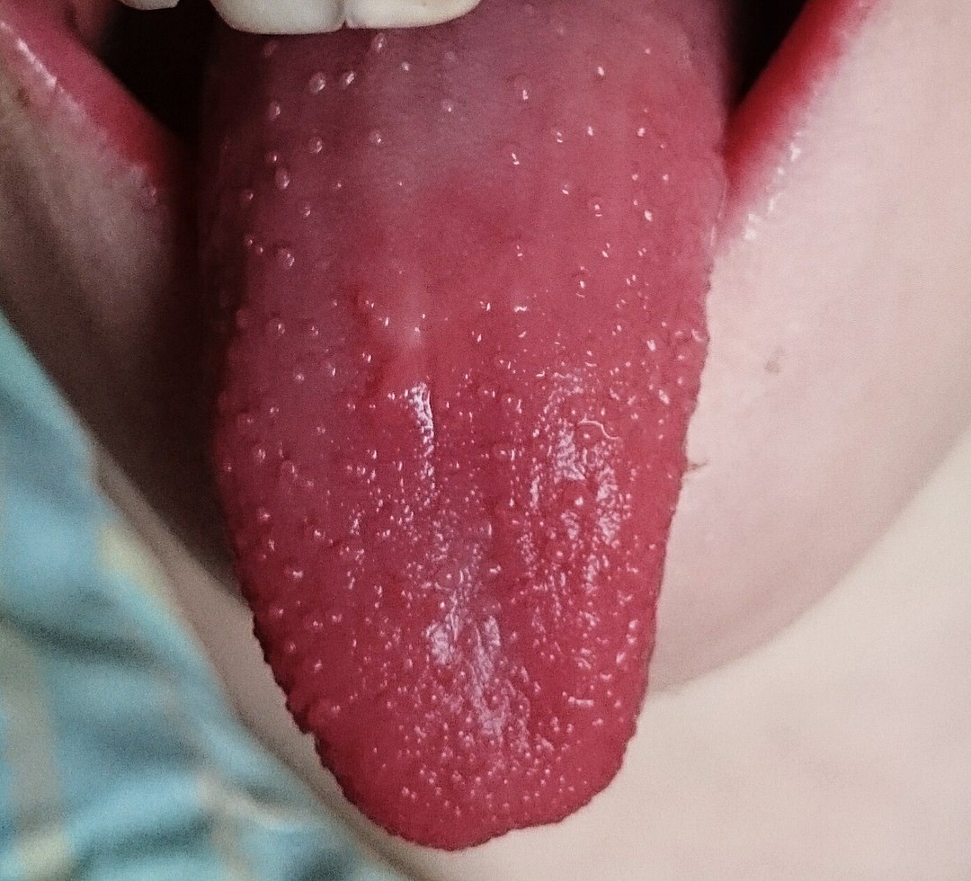 Escarlatina lengua