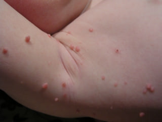 Molusco Contagioso