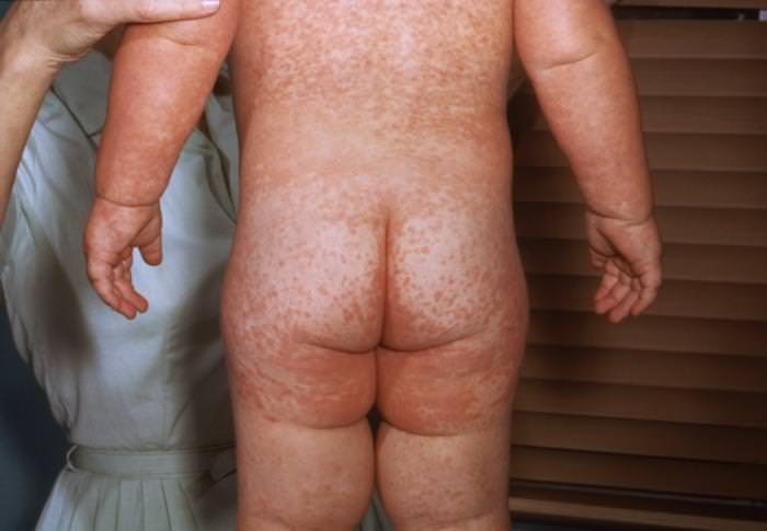 Sarampión rash